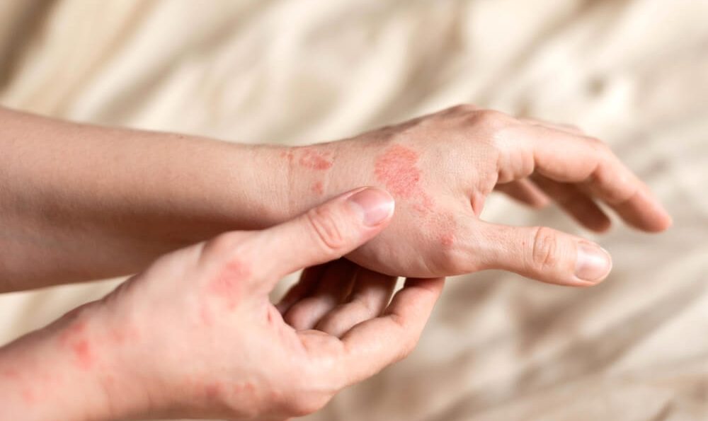 juckendes Ekzem: Hände mit roten Ekzemen.