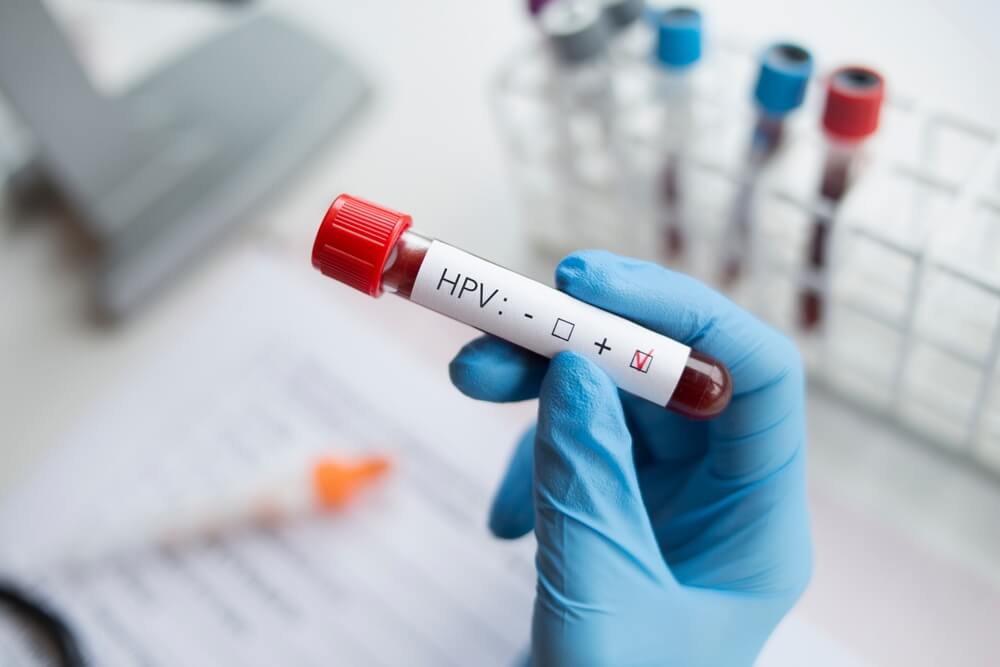 HPV positiv: Blutprobe mit HPV positiv Ergebnis
