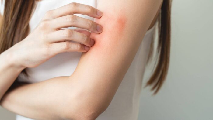 Frau hat gerötetet Hautausschlag auf ihrem Oberarm