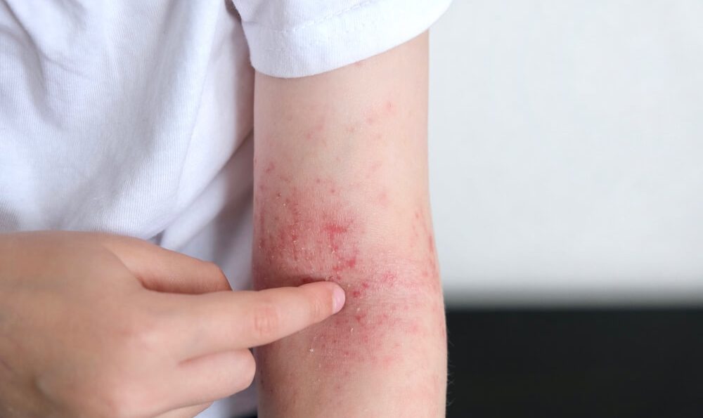 Kind mit Neurodermitis-Ausschlag am Arm