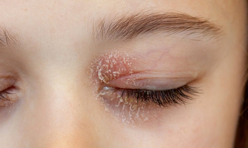 Neurodermitis am Auge