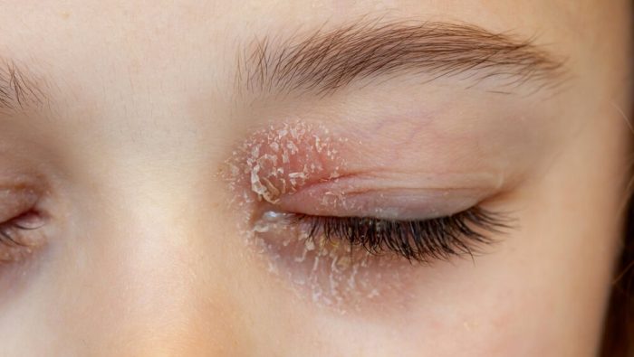 Neurodermitis an den Augen: Was hilft?