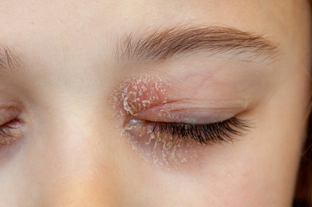 Neurodermitis an den Augen: Was hilft?