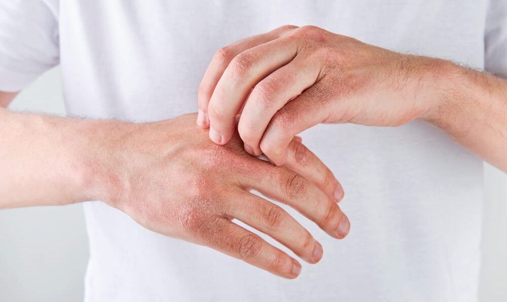 Neurodermitis an den Händen: rote, schuppige Haut