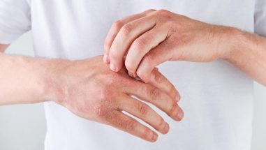 Zum Artikel: Neurodermitis an den Händen: rote, schuppige Haut