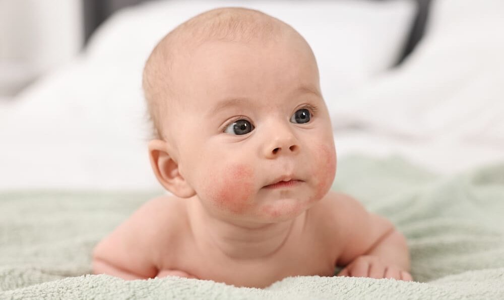 Baby mit Neurodermitis-Ausschlag auf der Wange