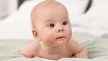 Zum Artikel: Baby mit Neurodermitis-Ausschlag auf der Wange