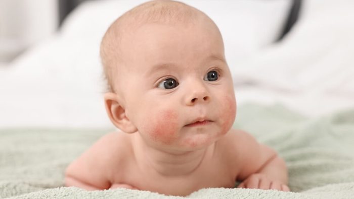 Baby mit Neurodermitis-Ausschlag auf der Wange