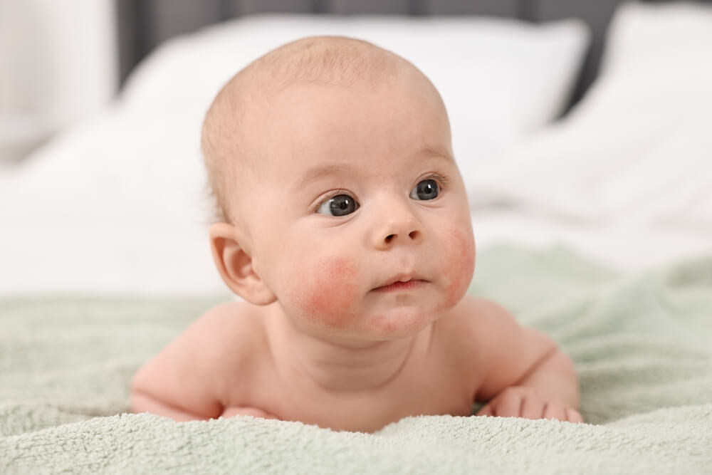 Neurodermitis bei Babys und Kindern