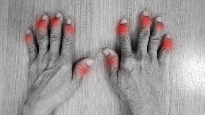 Psoriasis-Arthritis: Hände mit geschwollenen geröteten Fingern.