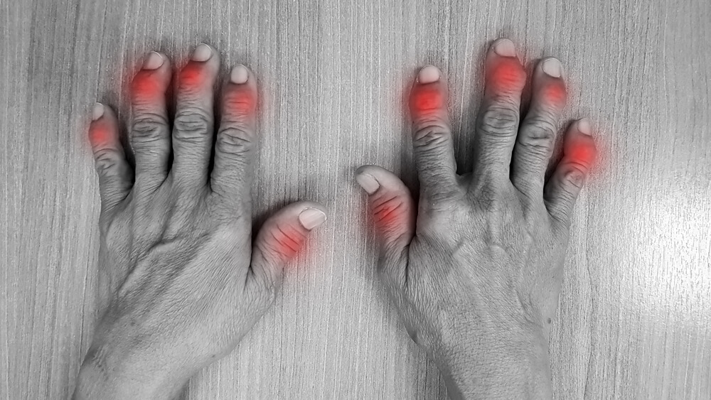Psoriasis-Arthritis: Hände mit geschwollenen geröteten Fingern.
