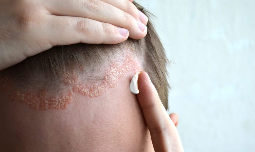 Mann mit Psoriasis auf der Kopfhaut