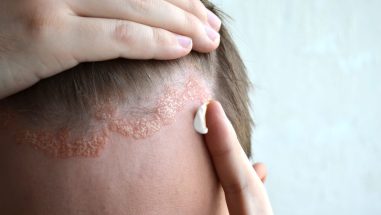 Zum Artikel: Mann mit Psoriasis auf der Kopfhaut