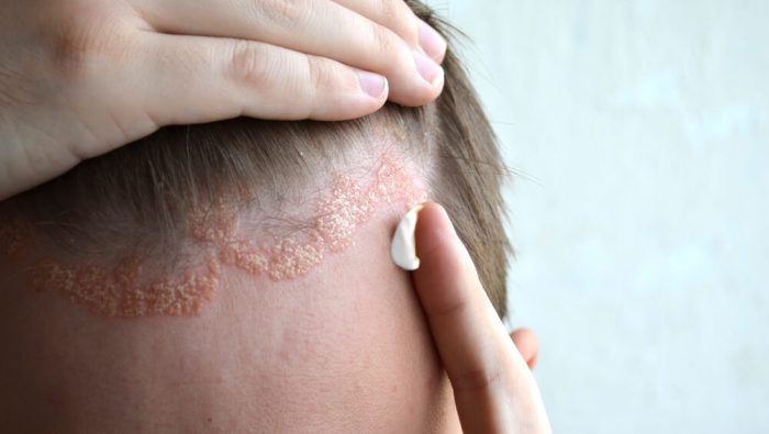 Mann mit Psoriasis auf der Kopfhaut