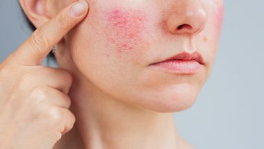 Zum Artikel: Junge Frau mit typischen Rosacea (Rosazea)-Ausschlag auf der Wange