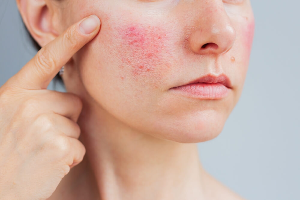 Rosacea - Ursache, Symptome und Behandlung
