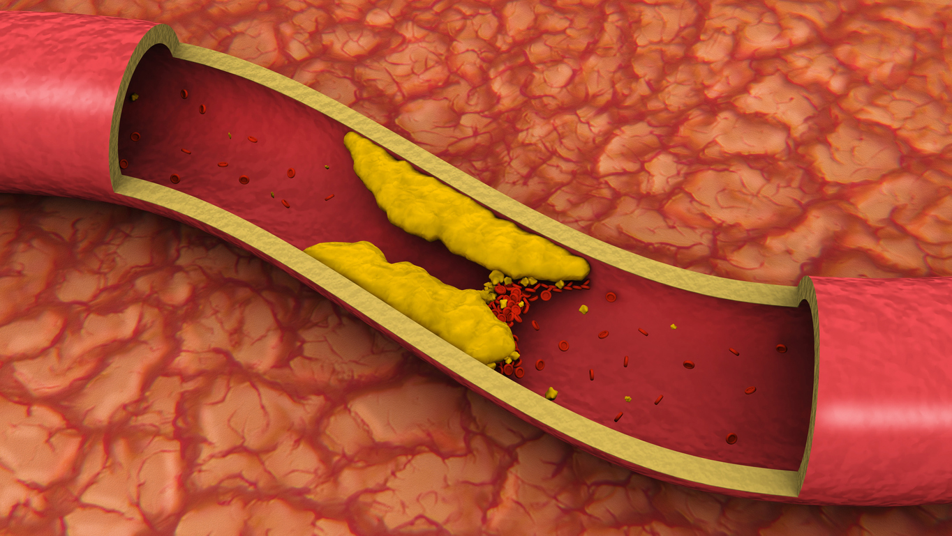 Verstopfte Arterie in 3D