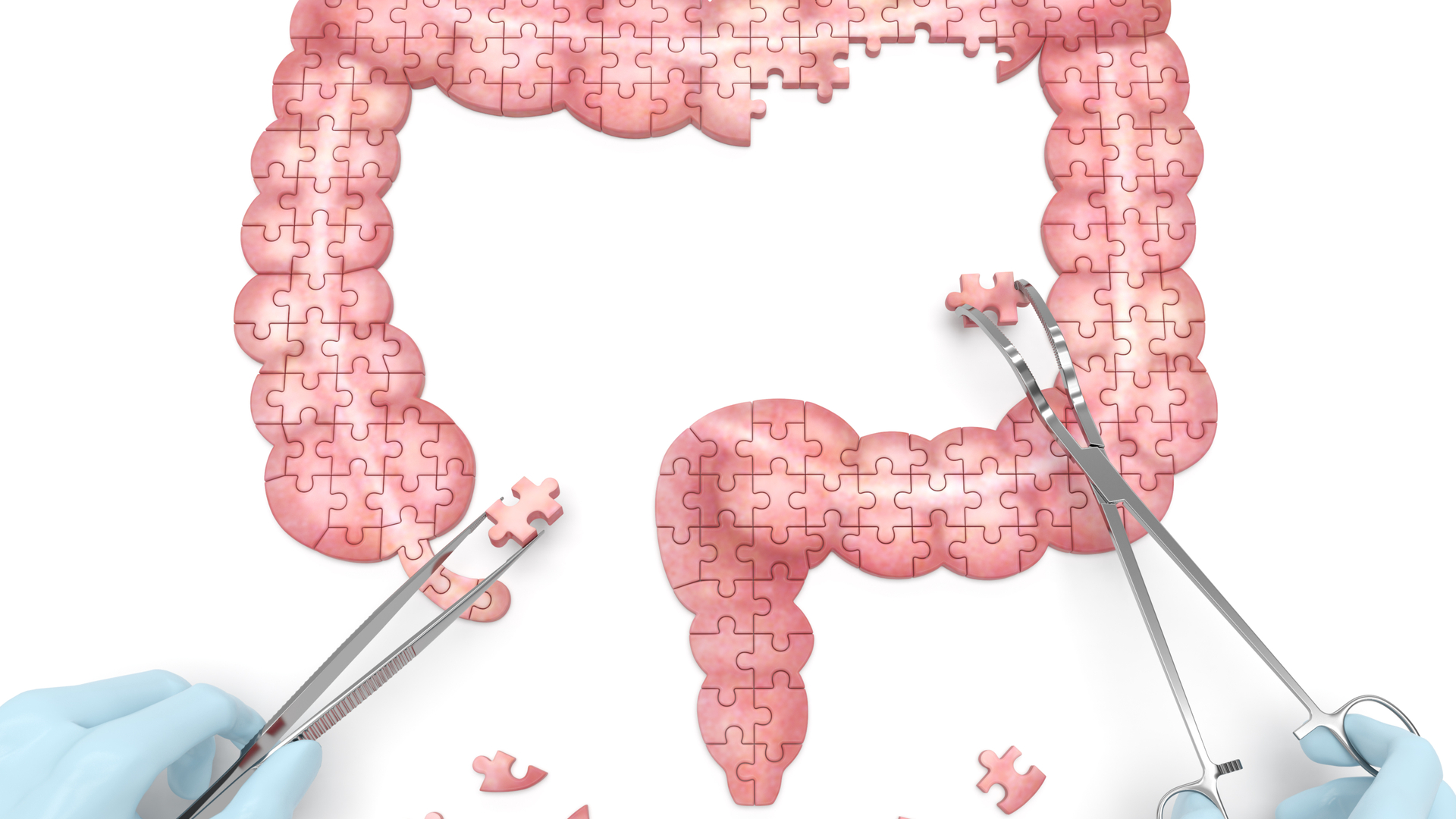 Colitis ulcerosa DocFinder Wissensmagazin