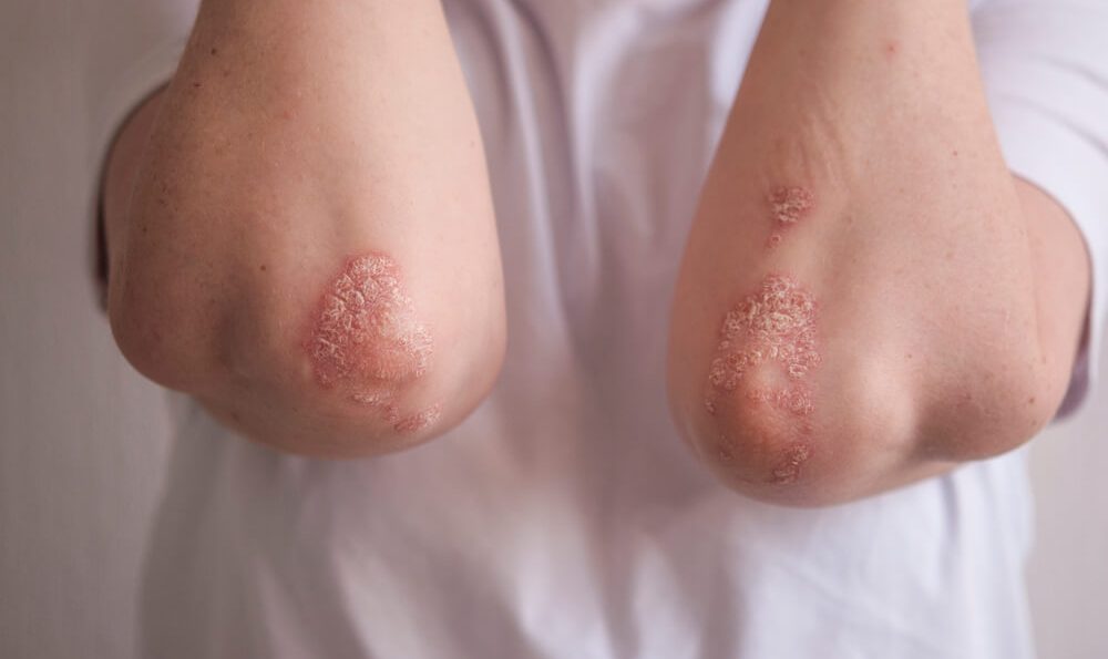 Psoriasis-Stellen am Ellenbogen