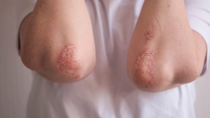 Psoriasis-Stellen am Ellenbogen