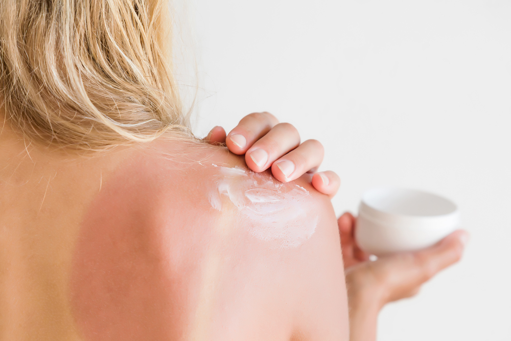 Medikamente & Hausmittel bei Sonnenbrand: Was hilft?